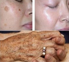 REMOVE AND PREVENT BROWN SPOTS WITH THESE 2 NATURAL INGREDIENTS. AMAZING!