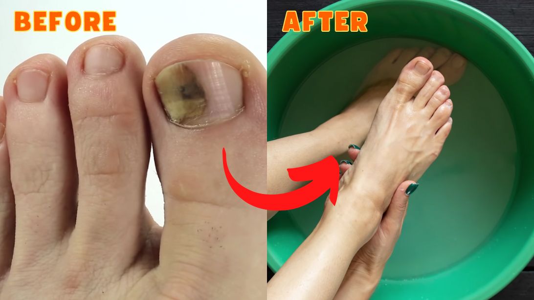 3 Simple and Effective Natural Cures for Toenail Fungus