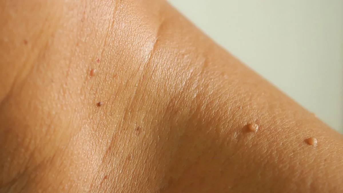 How To Remove Moles, Warts, Blackheads, Skin Tags, And Age Spots Completely Naturally